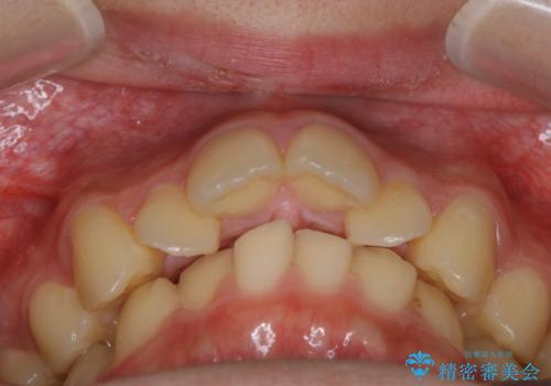 非抜歯で劇的に出っ歯を改善!インビザラインとカリエールの組み合わせ治療の治療前