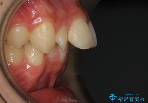 非抜歯で劇的に出っ歯を改善!インビザラインとカリエールの組み合わせ治療の症例 治療前