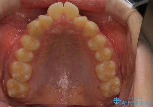 非抜歯で劇的に出っ歯を改善!インビザラインとカリエールの組み合わせ治療の治療前