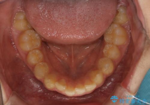 非抜歯で劇的に出っ歯を改善!インビザラインとカリエールの組み合わせ治療の治療前