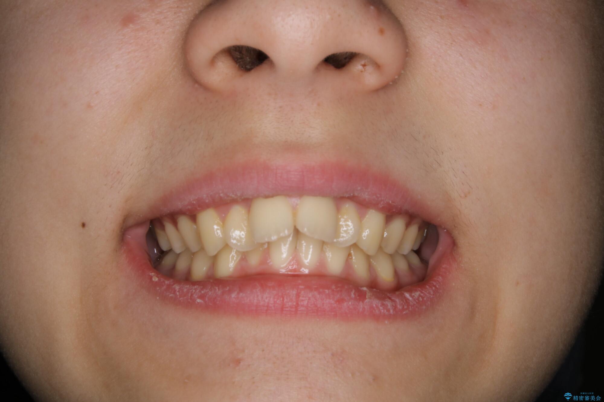 非抜歯で劇的に出っ歯を改善!インビザラインとカリエールの組み合わせ治療の治療前(顔貌)