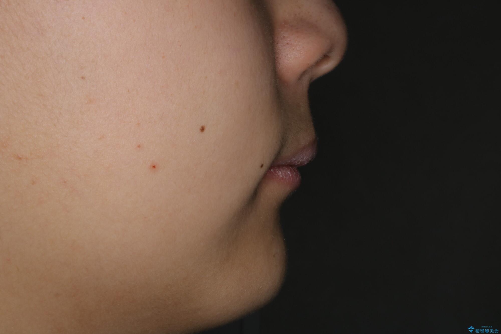 非抜歯で劇的に出っ歯を改善!インビザラインとカリエールの組み合わせ治療の治療前(顔貌)