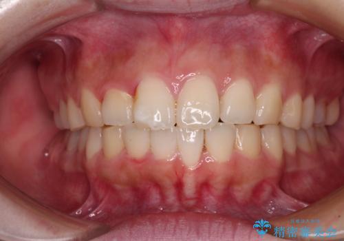 前歯のデコボコをインビザラインできれいに整えるの治療中