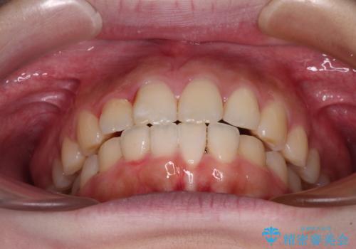 前歯のデコボコをインビザラインできれいに整えるの治療中