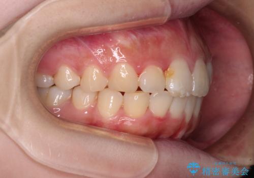 前歯のデコボコをインビザラインできれいに整えるの治療中