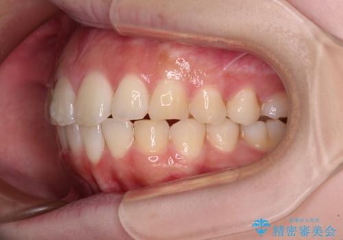 前歯のデコボコをインビザラインできれいに整えるの治療中