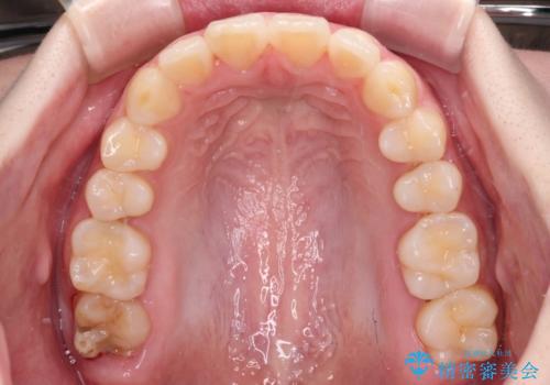 前歯のデコボコをインビザラインできれいに整えるの治療中
