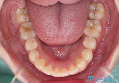 前歯のデコボコをインビザラインできれいに整えるの治療中