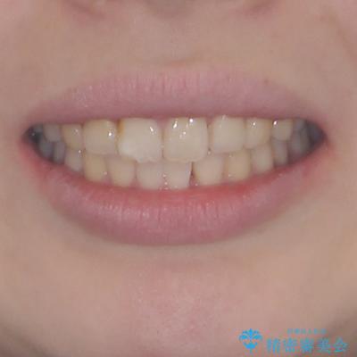 前歯のデコボコをインビザラインできれいに整えるの治療前(顔貌)