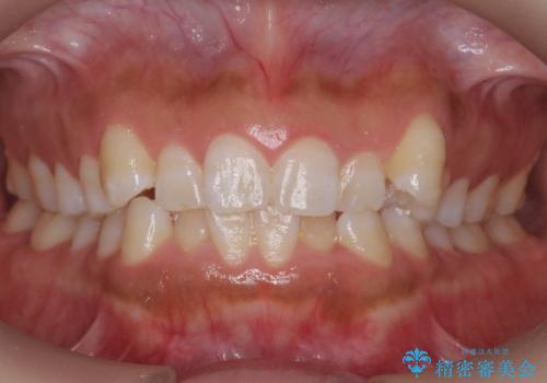 八重歯を非抜歯で　マウスピースで治療　奥歯を後ろに下げてすき間を確保の症例 治療前
