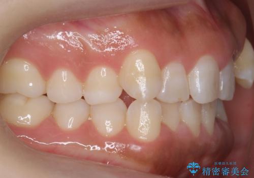 八重歯を非抜歯で　マウスピースで治療　奥歯を後ろに下げてすき間を確保の治療前