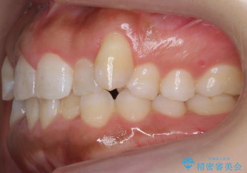 八重歯を非抜歯で マウスピースで治療 奥歯を後ろに下げてすき間を確保の治療前