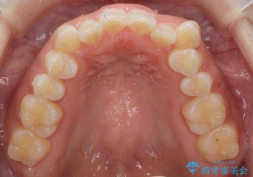 八重歯を非抜歯で　マウスピースで治療　奥歯を後ろに下げてすき間を確保の治療前