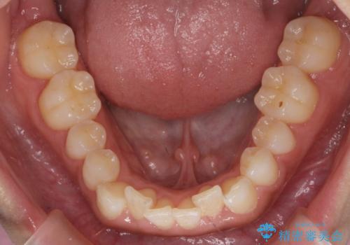 八重歯を非抜歯で マウスピースで治療 奥歯を後ろに下げてすき間を確保の治療前