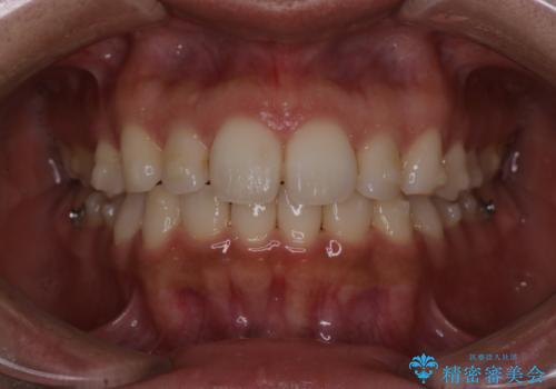 【インビザライン】前歯の後戻りを再矯正の治療中