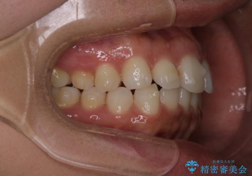 【インビザライン】前歯の後戻りを再矯正の治療中