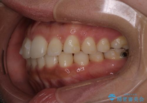 【インビザライン】前歯の後戻りを再矯正の治療中