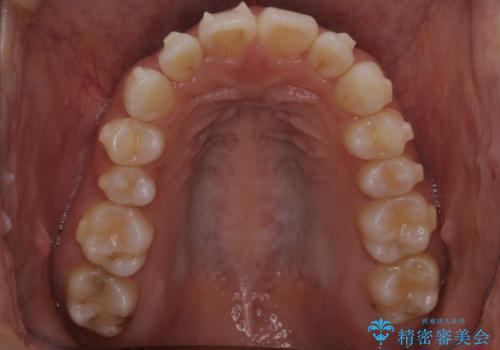 【インビザライン】前歯の後戻りを再矯正の治療中