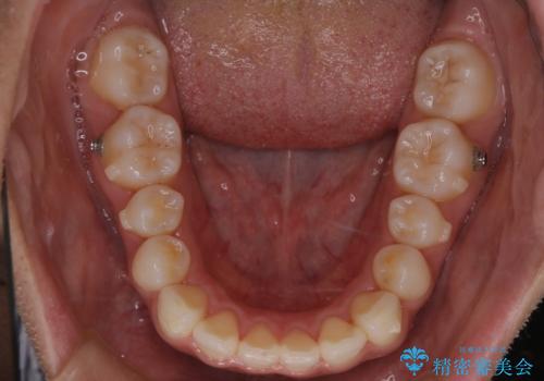 【インビザライン】前歯の後戻りを再矯正の治療中