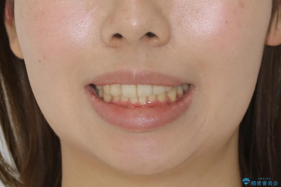 【非抜歯】インビザラインでガタつきと口元を改善!非抜歯でも印象が変わる矯正治療の治療後(顔貌)