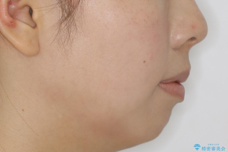 【非抜歯】インビザラインでガタつきと口元を改善!非抜歯でも印象が変わる矯正治療の治療後(顔貌)