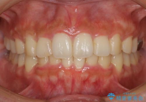 【非抜歯】インビザラインでガタつきと口元を改善!非抜歯でも印象が変わる矯正治療の症例 治療後