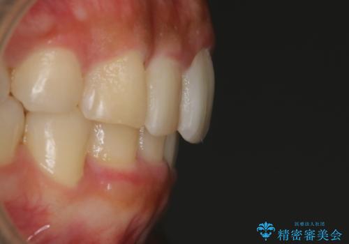 【非抜歯】インビザラインでガタつきと口元を改善!非抜歯でも印象が変わる矯正治療の治療後