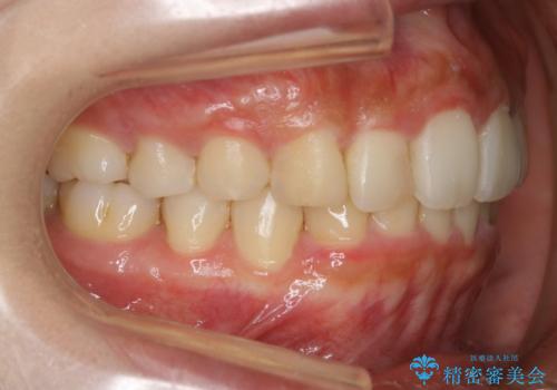 【非抜歯】インビザラインでガタつきと口元を改善!非抜歯でも印象が変わる矯正治療の治療後