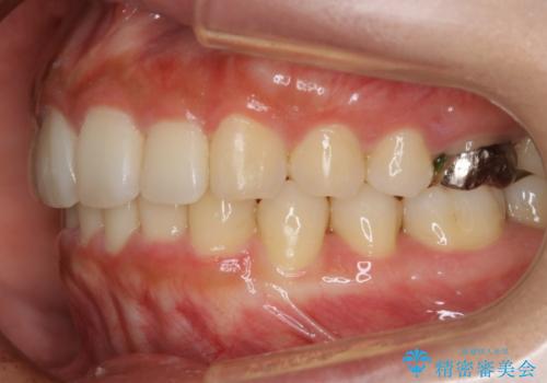 【非抜歯】インビザラインでガタつきと口元を改善!非抜歯でも印象が変わる矯正治療の治療後