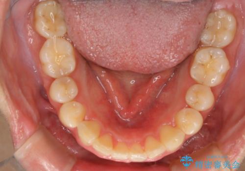 【非抜歯】インビザラインでガタつきと口元を改善!非抜歯でも印象が変わる矯正治療の治療後