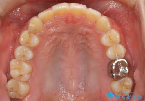 【非抜歯】インビザラインでガタつきと口元を改善!非抜歯でも印象が変わる矯正治療の治療後