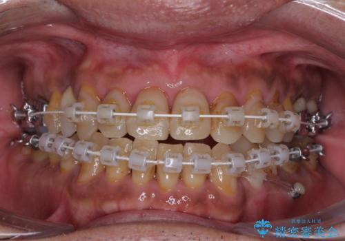 今からでも綺麗な歯並びを手に入れたい 40代男性のワイヤー矯正の治療中