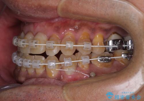 今からでも綺麗な歯並びを手に入れたい 40代男性のワイヤー矯正の治療中