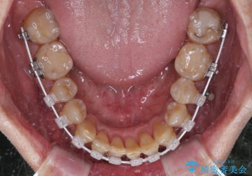 今からでも綺麗な歯並びを手に入れたい 40代男性のワイヤー矯正の治療中