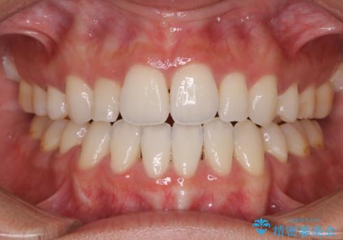 【ワイヤー矯正】口元を歯列矯正で下げたいの症例 治療後