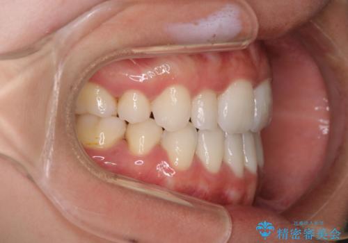 【ワイヤー矯正】口元を歯列矯正で下げたいの治療後