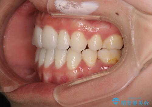 【ワイヤー矯正】口元を歯列矯正で下げたいの治療後