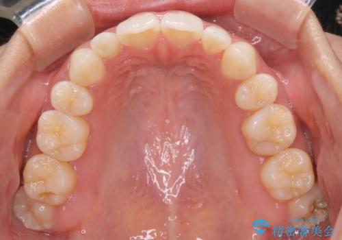 【ワイヤー矯正】口元を歯列矯正で下げたいの治療後