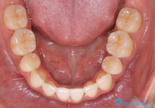 【ワイヤー矯正】口元を歯列矯正で下げたいの治療後