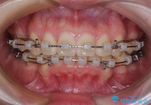 飛び出した上顎前歯 抜歯矯正でスッキリとした横顔にの治療中