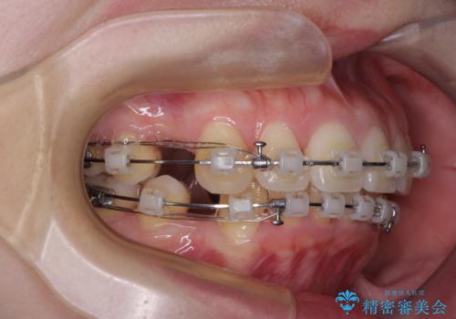飛び出した上顎前歯 抜歯矯正でスッキリとした横顔にの治療中