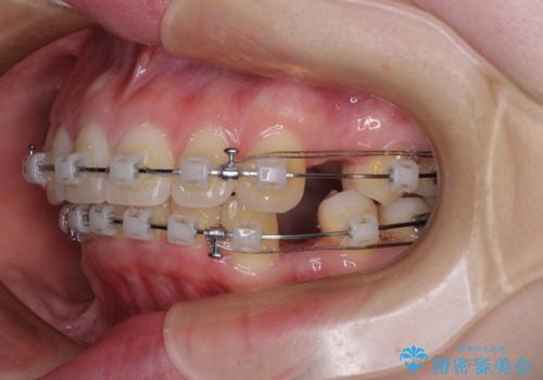 飛び出した上顎前歯 抜歯矯正でスッキリとした横顔にの治療中