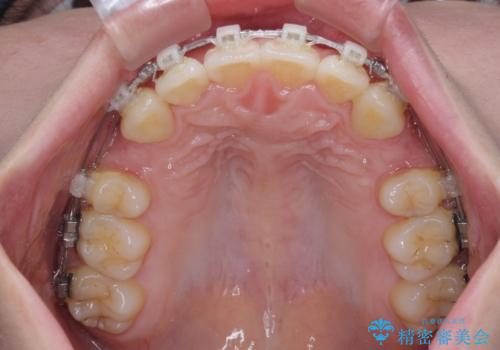 飛び出した上顎前歯 抜歯矯正でスッキリとした横顔にの治療中