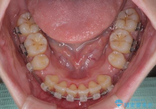 飛び出した上顎前歯 抜歯矯正でスッキリとした横顔にの治療中