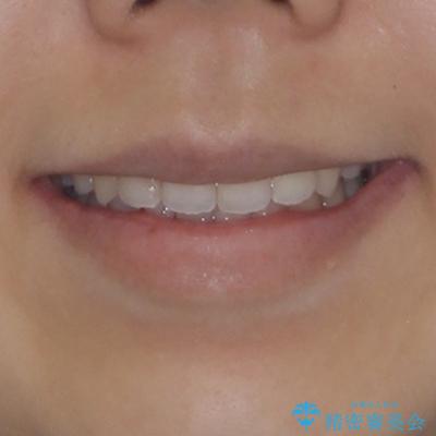後戻りの再矯正 ワイヤー装置でデコボコと隙間を改善の治療後(顔貌)