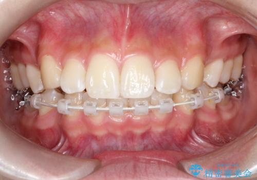 裏側矯正で口元をすっきりとした印象へ!の治療中