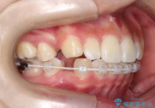 裏側矯正で口元をすっきりとした印象へ!の治療中