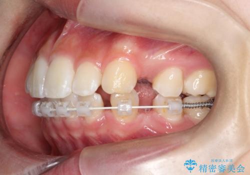 裏側矯正で口元をすっきりとした印象へ!の治療中