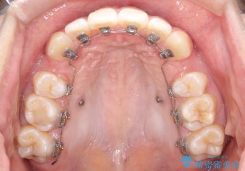 裏側矯正で口元をすっきりとした印象へ!の治療中