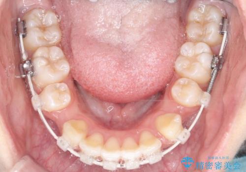 裏側矯正で口元をすっきりとした印象へ!の治療中